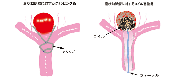 解離性脳動脈瘤06