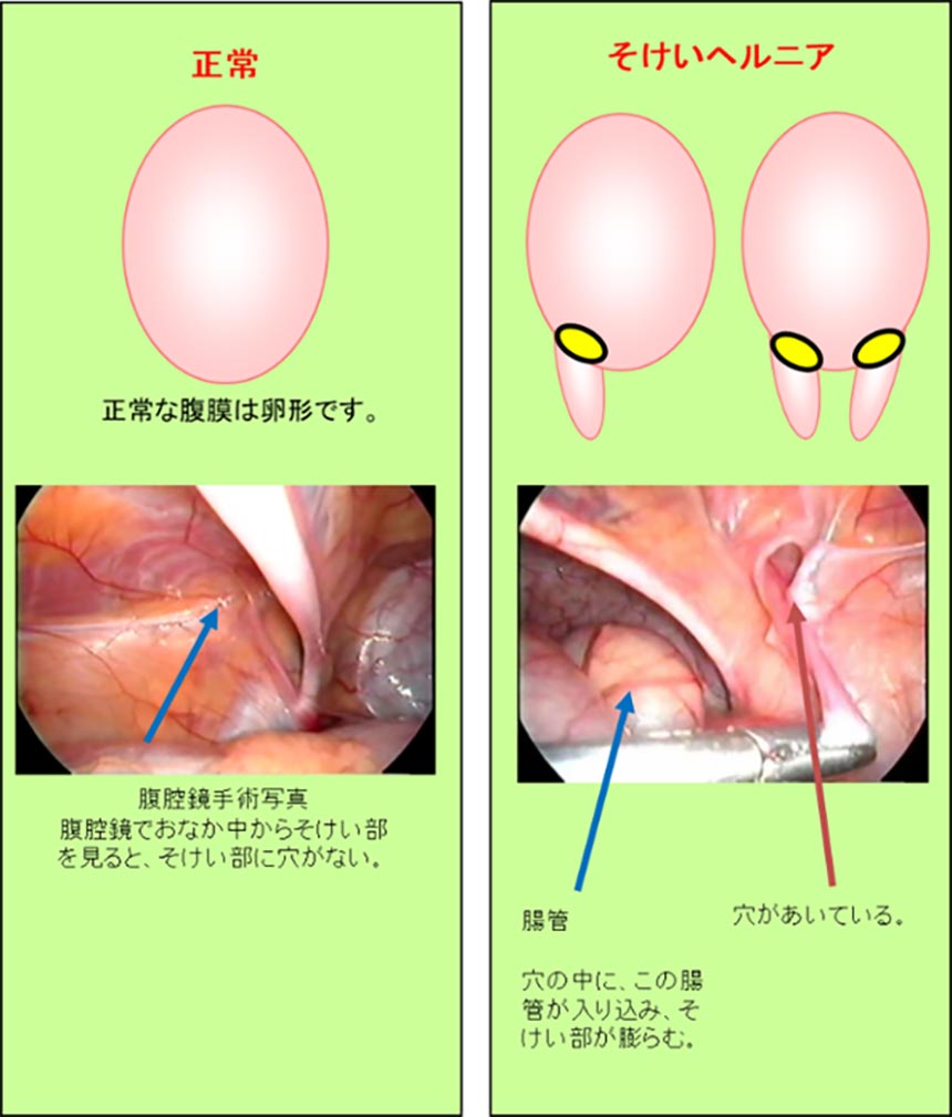 小児外科02