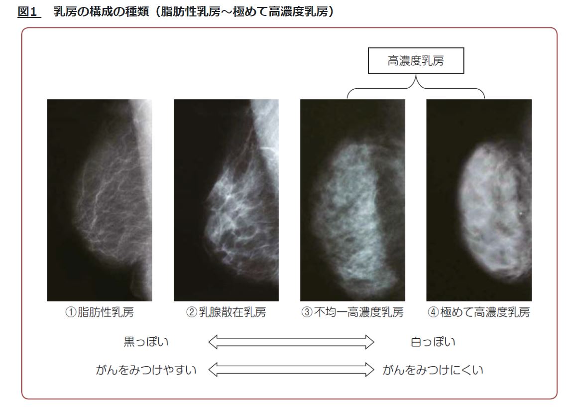 遺伝性乳がん卵巣がん症候群と乳がん検診について（乳腺外科