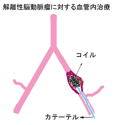 解離性脳動脈瘤07
