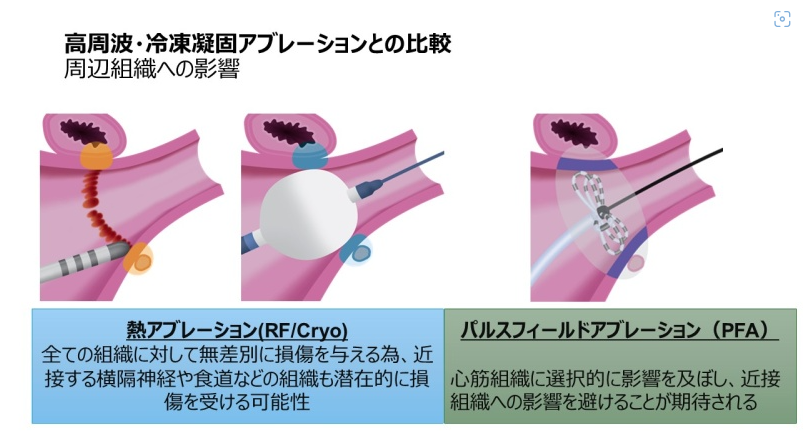 循環器内科(PFA)医療トピックス