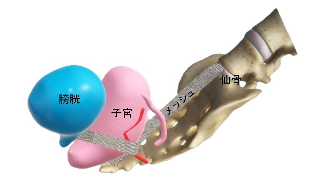 仙骨膣固定術_page-0001