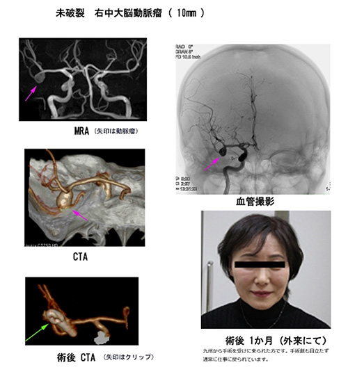 脳動脈瘤20