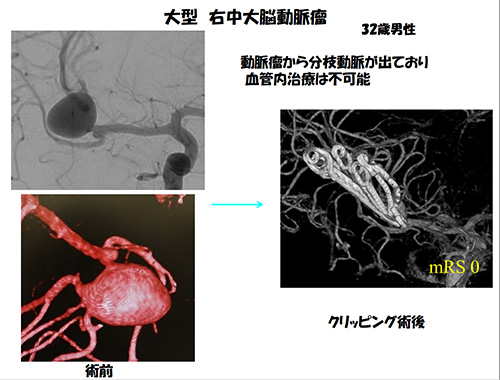 脳動脈瘤23