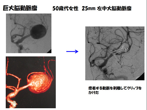 脳動脈瘤24