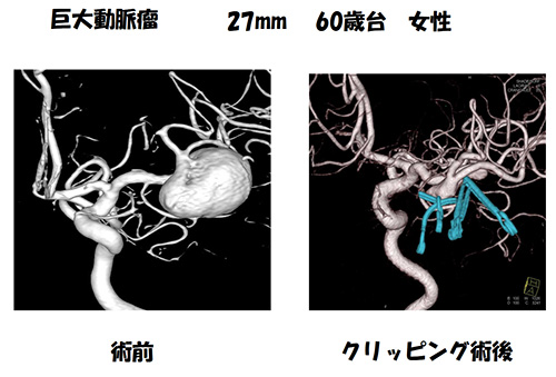 脳動脈瘤25