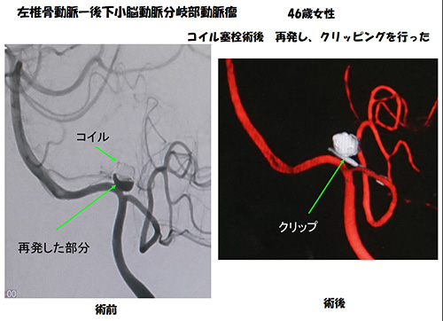 脳動脈瘤26