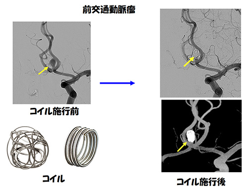 脳動脈瘤29