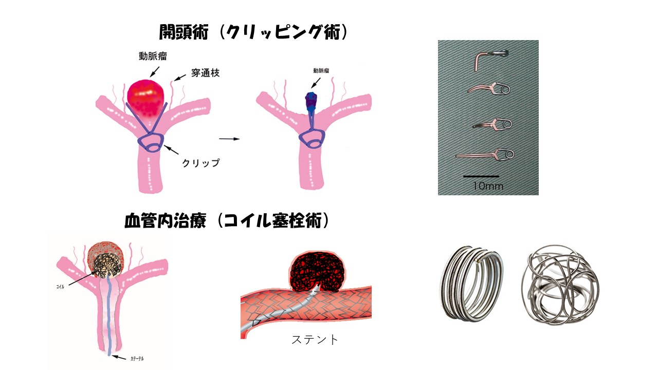 開頭手術と血管内治療