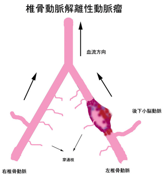 解離性脳動脈瘤08