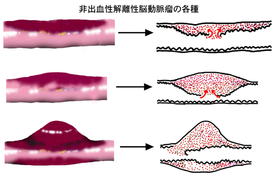 解離性脳動脈瘤09