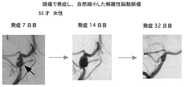 解離性脳動脈瘤10