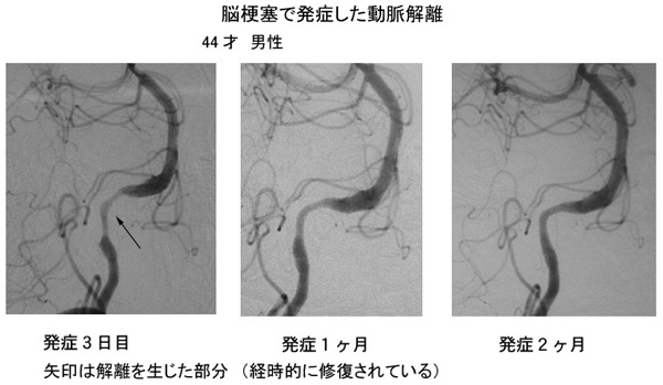 解離性脳動脈瘤11