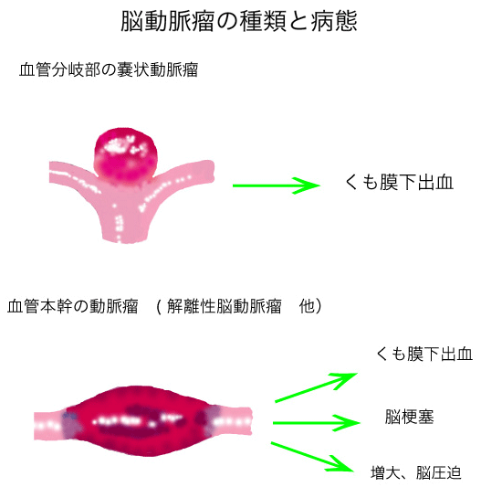 脳 動脈 瘤 消える