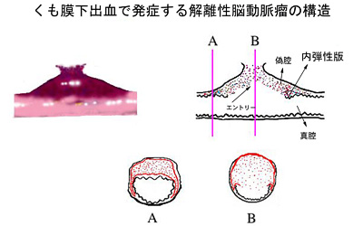 解離性脳動脈瘤03