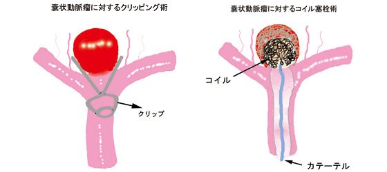 消える 脳 動脈 瘤 未破裂脳動脈瘤が発見されたときの注意点