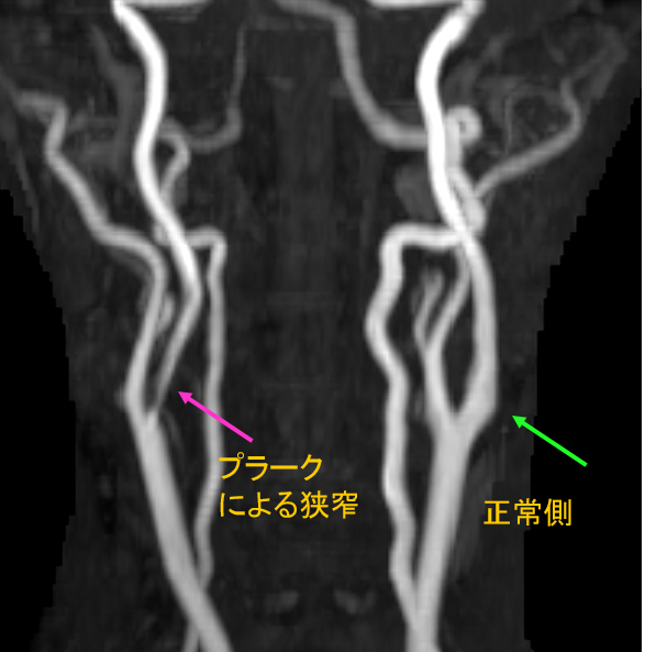 頚部動脈MRI、 MRA、プラーク性状診断