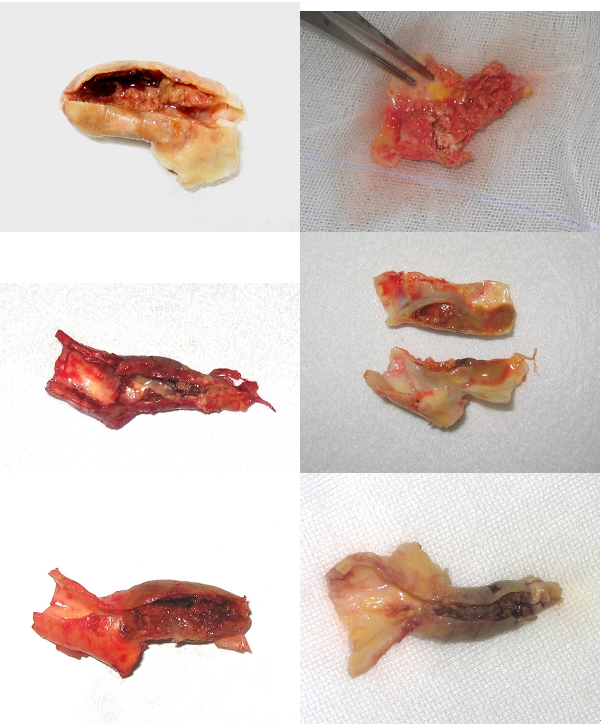 摘出した各種動脈硬化性プラーク