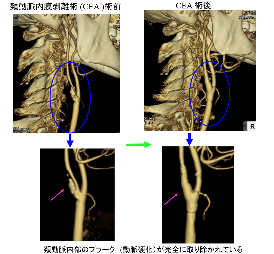 頸動脈内剥離術(CEA)術前と術後