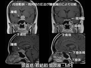 髄膜腫01