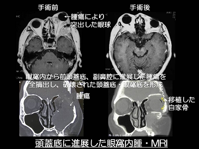 頭蓋底腫瘍03