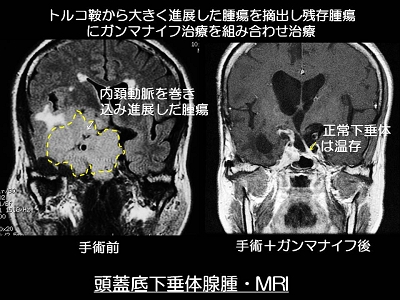 脳腫瘍（良性）・頭蓋底腫瘍・眼窩内腫瘍
