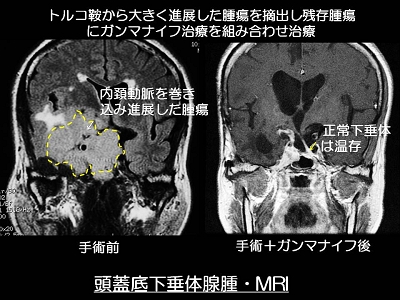 脳腫瘍 良性 頭蓋底腫瘍 眼窩内腫瘍 昭和大学病院