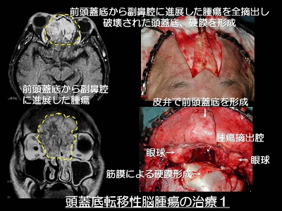 頭蓋底腫瘍01