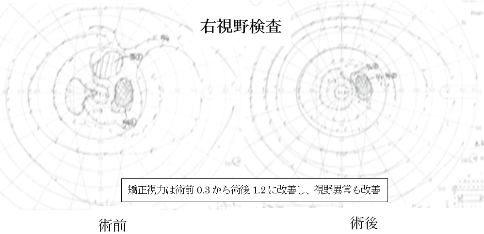 眼窩内腫瘍03