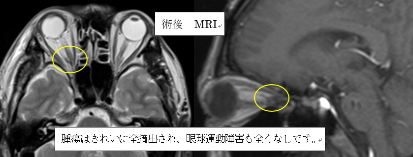 眼窩内腫瘍02