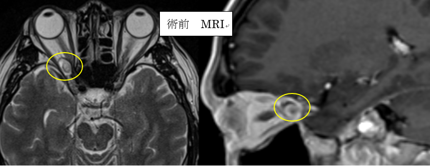 眼窩内腫瘍01