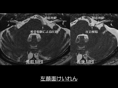 顔面けいれん