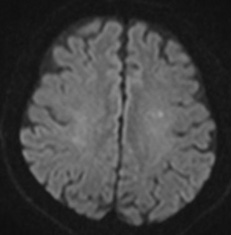 脳動脈バイパス01