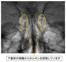 海綿静脈洞サンプリング