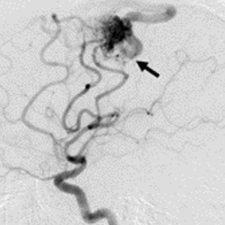 未破裂脳動静脈奇形 AVM3