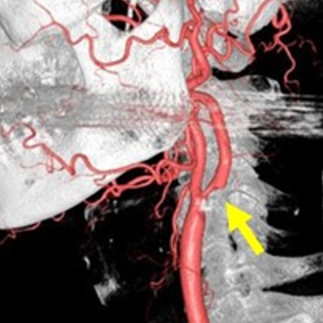 頚部頚動脈狭窄3
