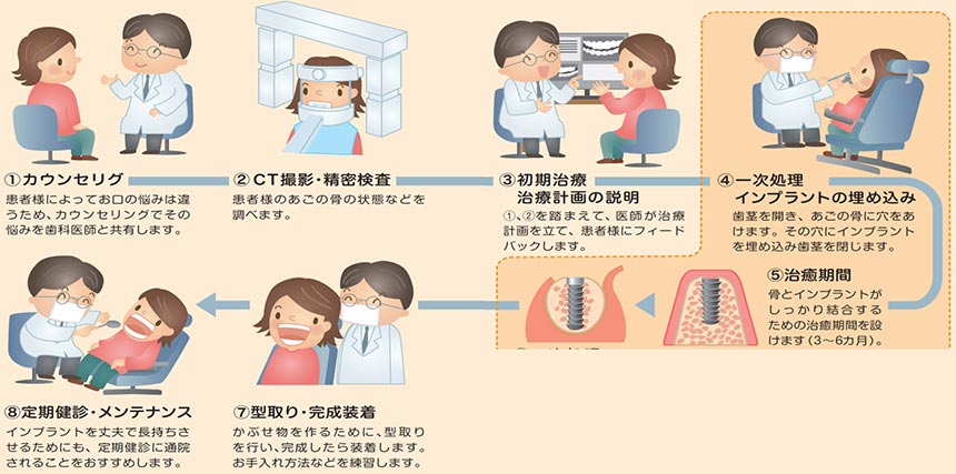 インプラント治療の一般的な流れ