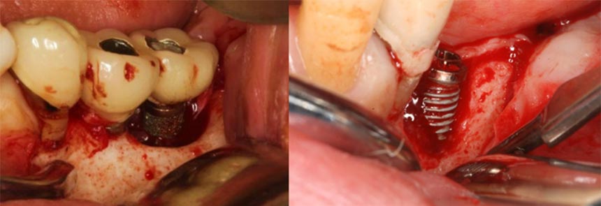 インプラント歯科_特徴的な診療領域07