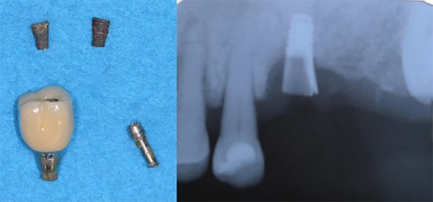 インプラント歯科_特徴的な診療領域06