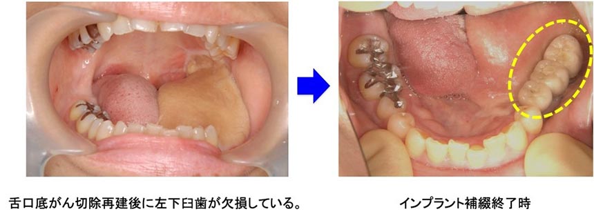 インプラントセンター_特徴的な診療領域03