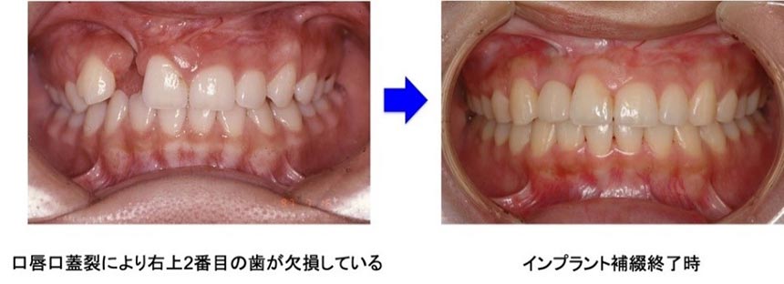 インプラントセンター_特徴的な診療領域02