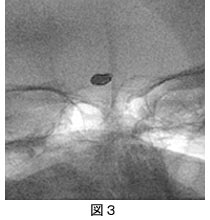 脳血管内治療03