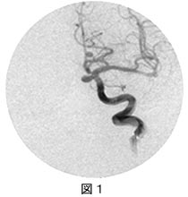 脳血管内治療01