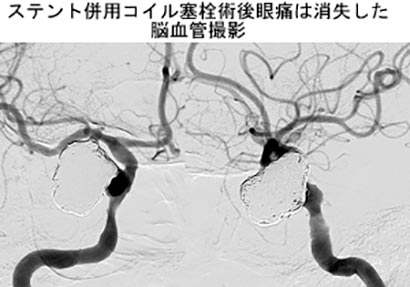 脳血管内治療10