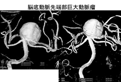 脳血管内治療04