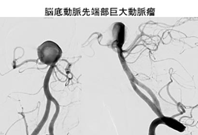 脳血管内治療05