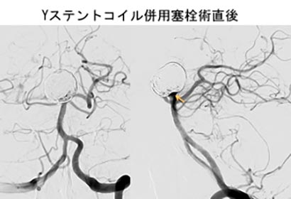 脳血管内治療06