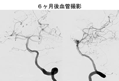 脳血管内治療07