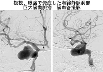 脳血管内治療08