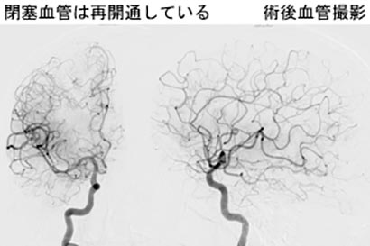 脳血管内治療14